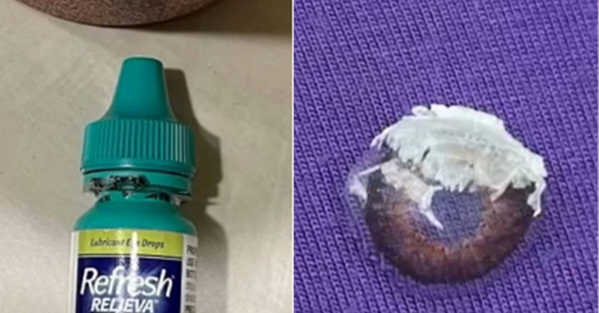 Woman’s Eye Glued Shut In Freak Accident Sharesplosion